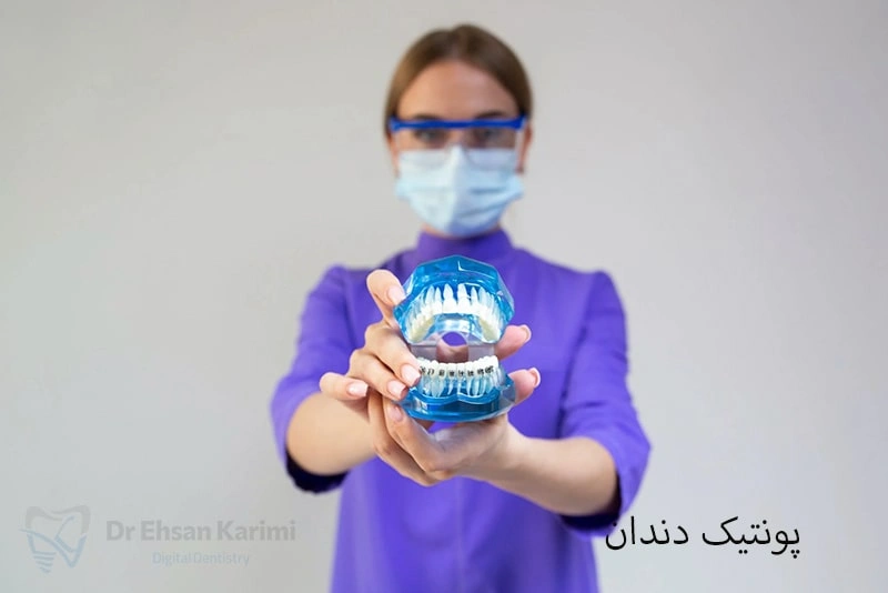 پونتیک دندان چیست؟ انواع پونتیک + مزایا و معایب