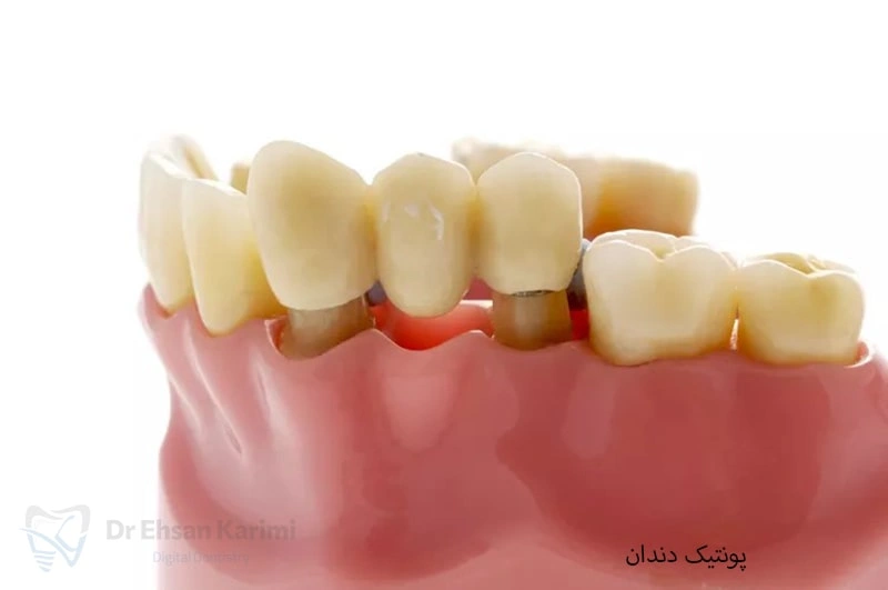 پونتیک دندان چیست؟