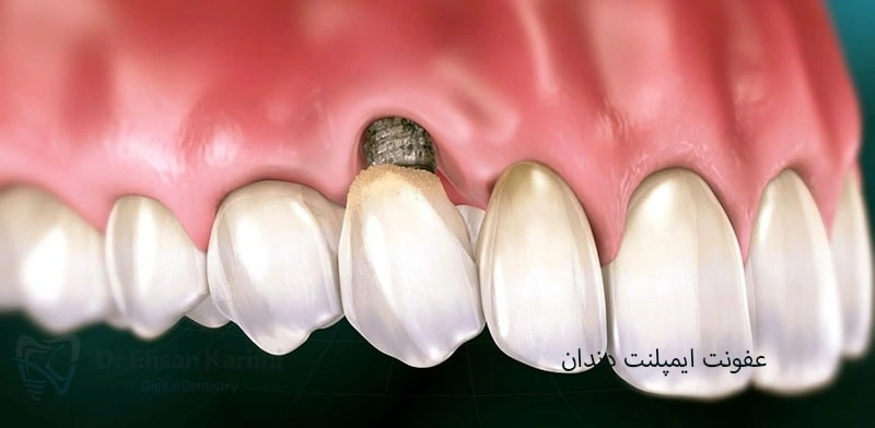  عفونت ایمپلنت دندان: علائم، عوارض و شیوه‌های جلوگیری