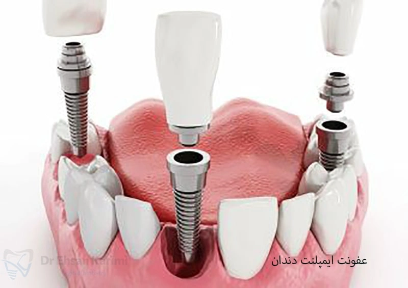  عفونت ایمپلنت دندان: علائم، عوارض و شیوه‌های جلوگیری