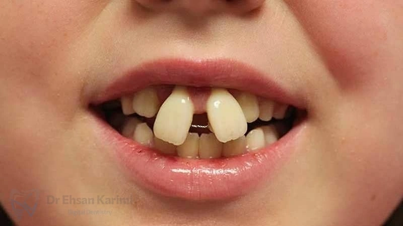 دندان خرگوشی چیست و چگونه درمان میشود؟