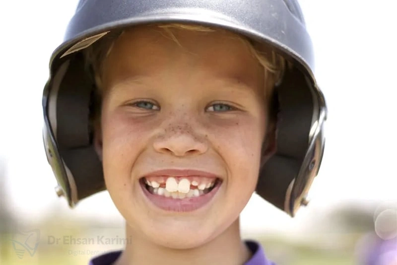 دندان خرگوشی چیست و چگونه درمان میشود؟