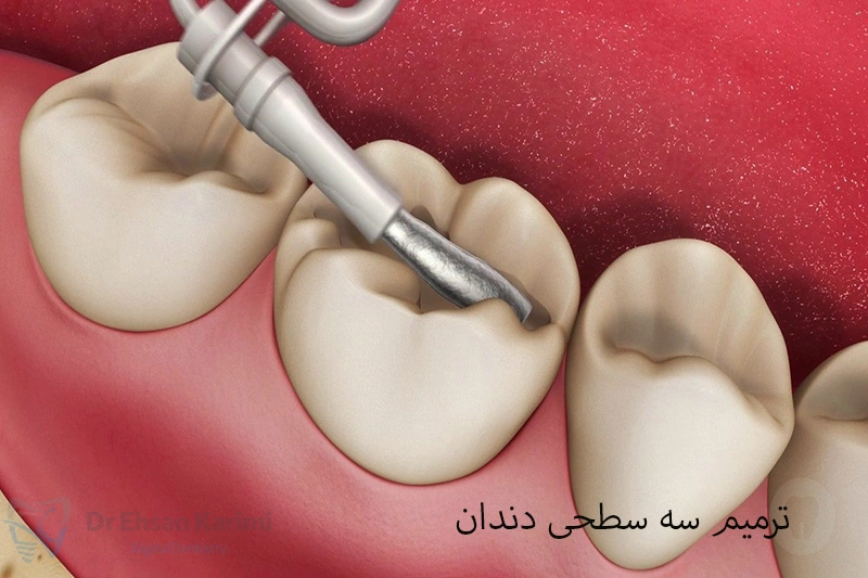 ترمیم سه سطحی دندان چیست؟