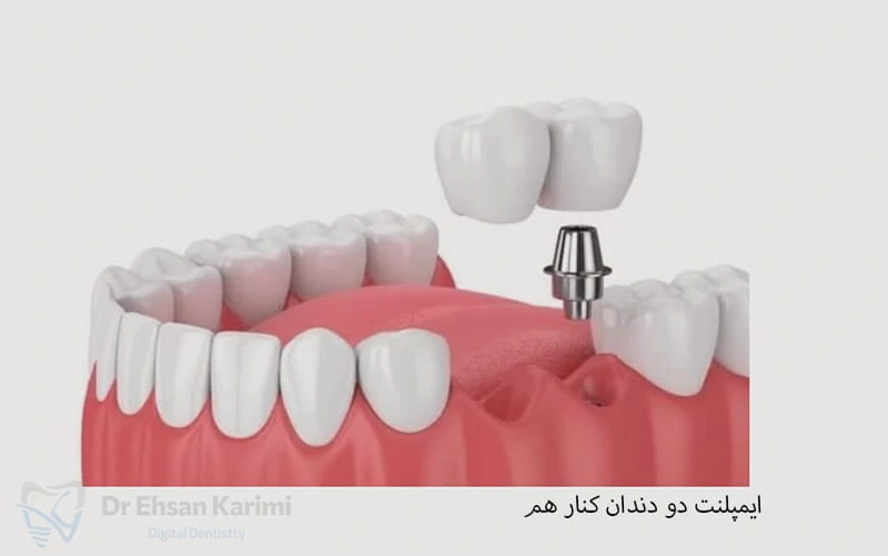  ایمپلنت دو دندان کنار هم چگونه انجام می‌شود؟