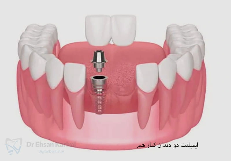  ایمپلنت دو دندان کنار هم چگونه انجام می‌شود؟