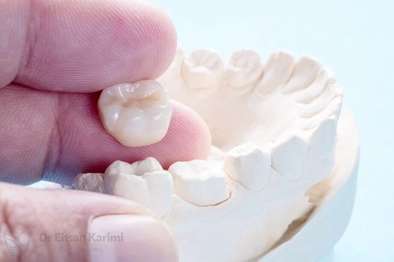بهترین دندانپزشک برای روکش دندان در مشهد کیست؟