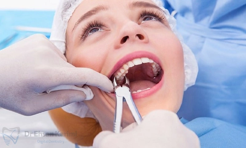 برای جراحی دندان عقل نهفته در مشهد چه کنیم؟