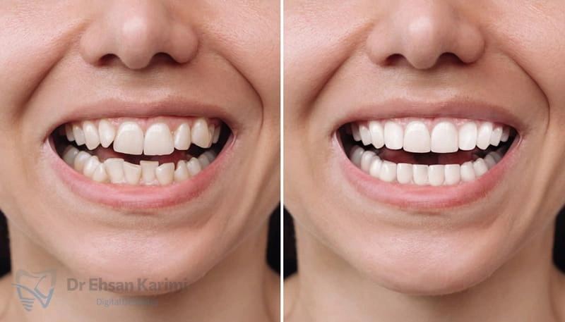 لمینت دندان چه کاربردی دارد و مزایا و معایب آن چیست؟