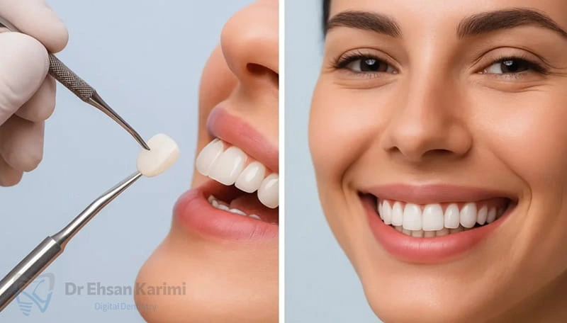 لمینت دندان چه کاربردی دارد؟