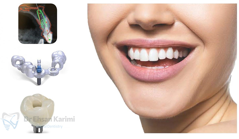 ایمپلنت دیجیتال یا سنتی؟ کدام برای شما مناسب‌ تر است؟