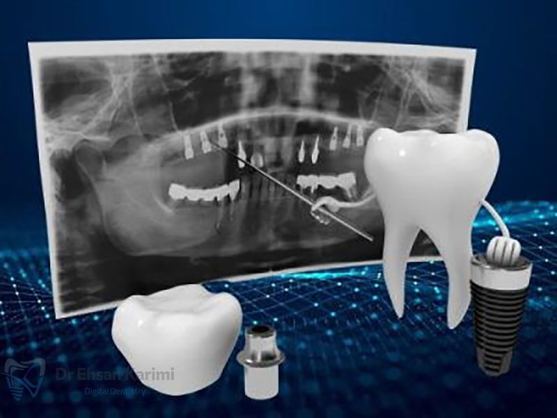 ایمپلنت دیجیتال یا سنتی؟