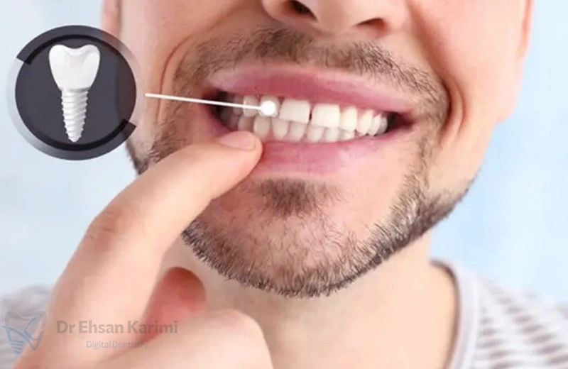 لق شدن ایمپلنت دندان به چه علتی است؟