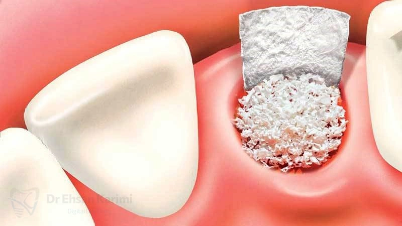 بهترین دندانپزشک ایمپلنت با پیوند استخوان در مشهد کیست؟