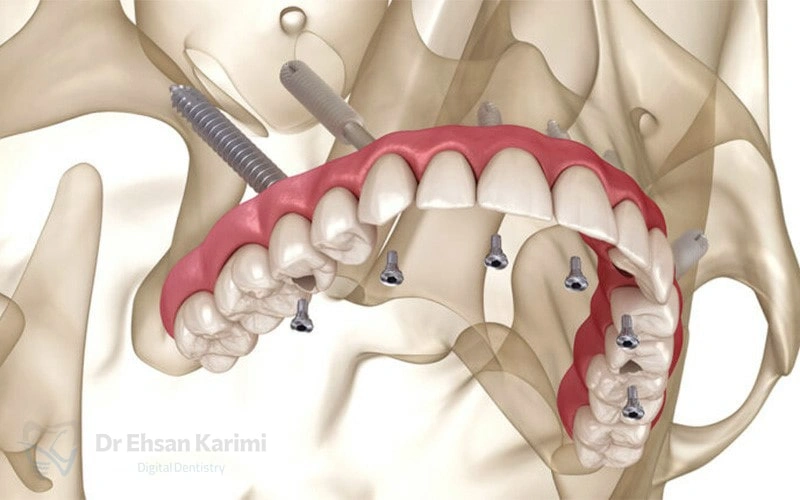 ایمپلنت زیگوماتیک چیست؟