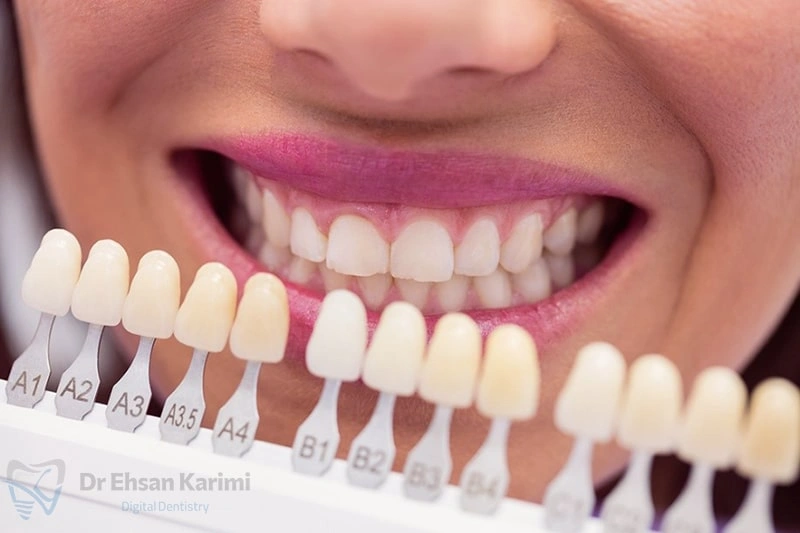بهترین متخصص لمینت دندان در مشهد کیست؟