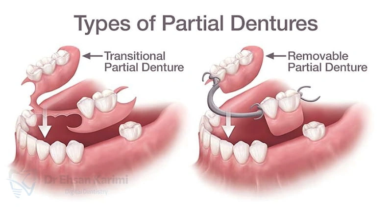 پروتز پارسیل چیست؟