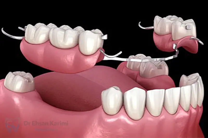 پروتز متحرک دندان چیست؟