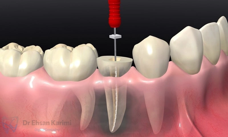 عصب کشی دندان چقدر طول میکشد؟ 