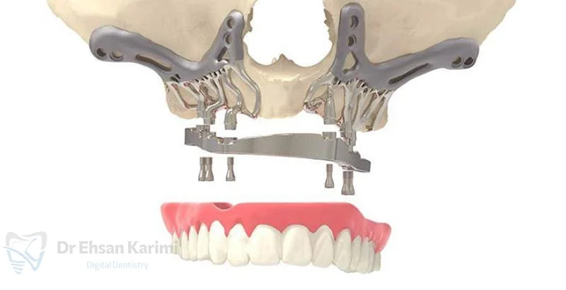 عوارض نصب ساب پریوستئال